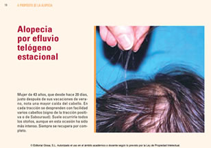 A propsito de la alopecia
