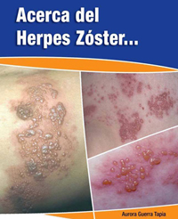 Acerca del Herpes Zoster