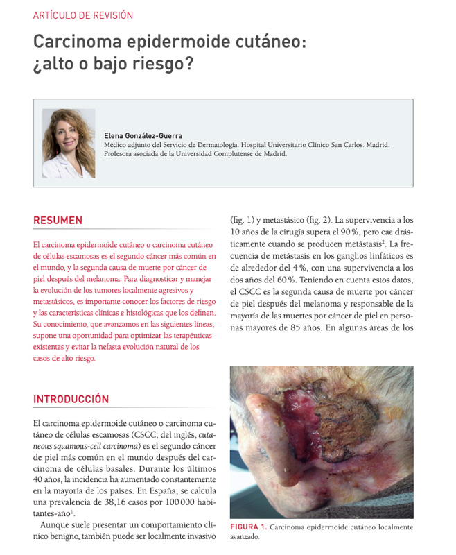 Carcinoma epidermoide cutneo: alto o bajo riesgo? 